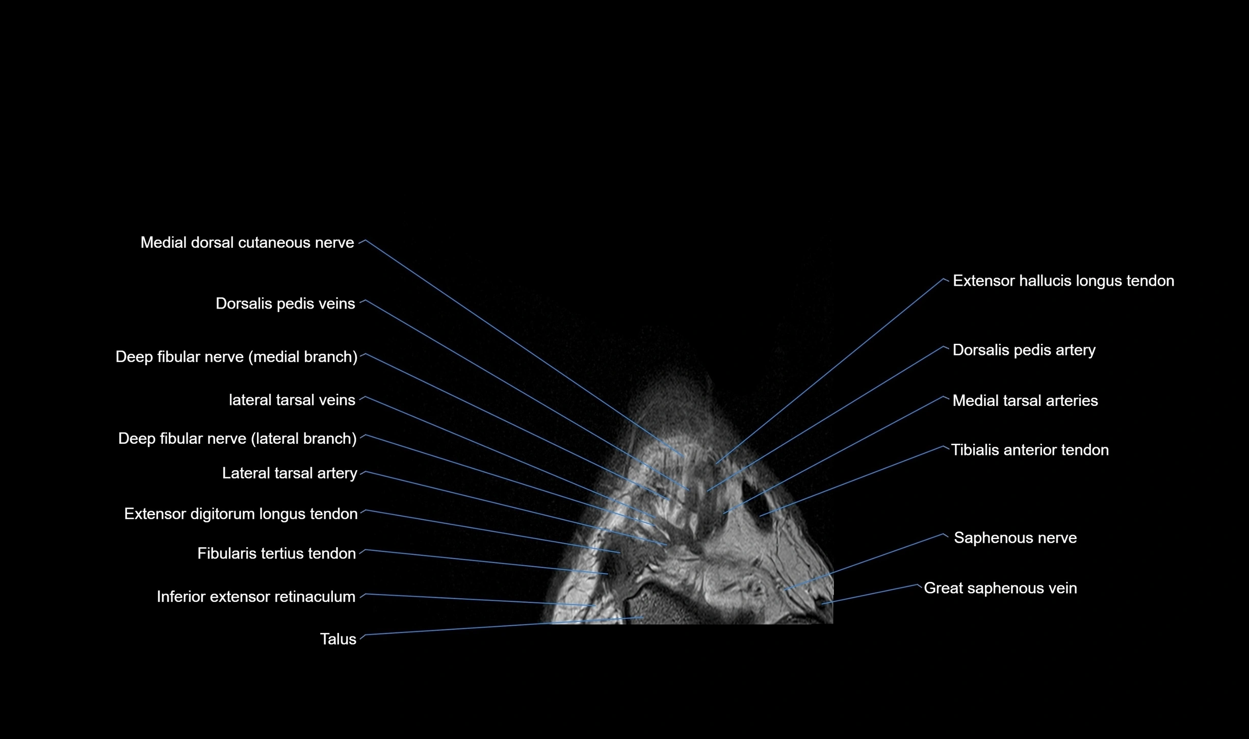 MRI mid foot coronal ligaments cross sectional anatomy 3T  radiology  image-img-00001-00007.webp